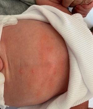 Newborn Rash Erythema Toxicum