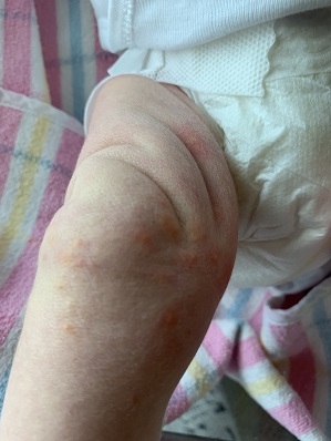 Erythema Toxicum